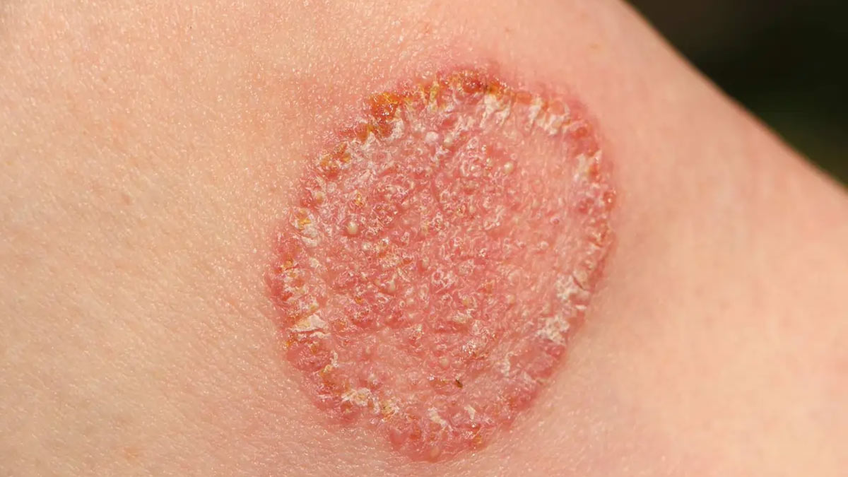 قارچ پوستی چیست