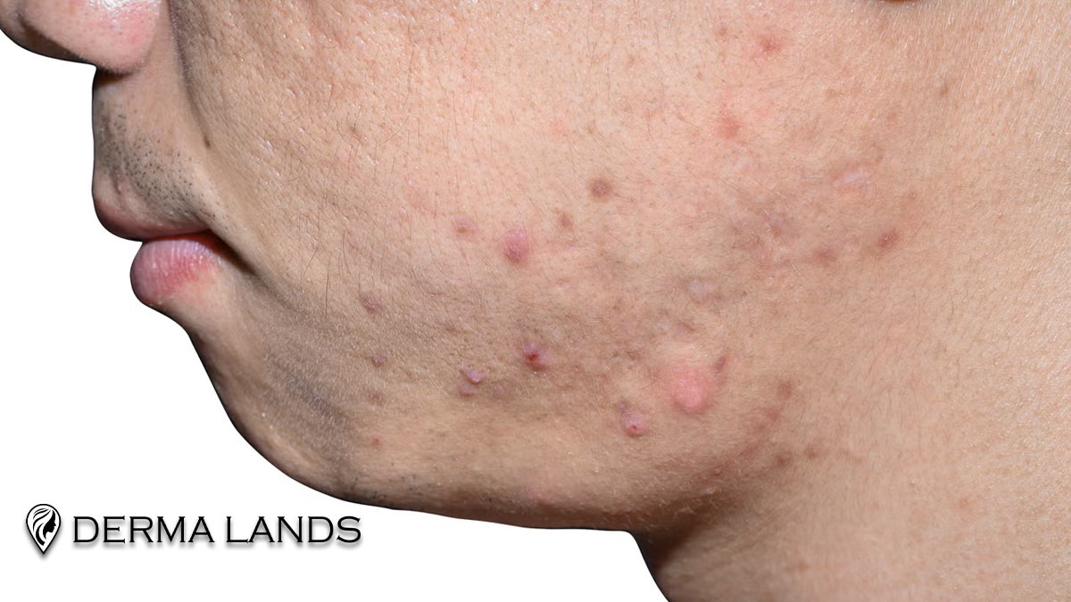 آکنه مکانیکا