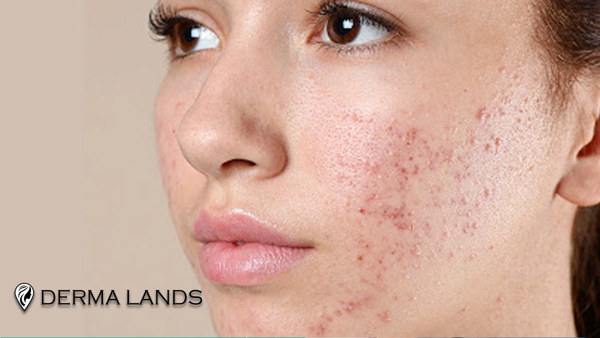 پوست چرب مستعد جوش