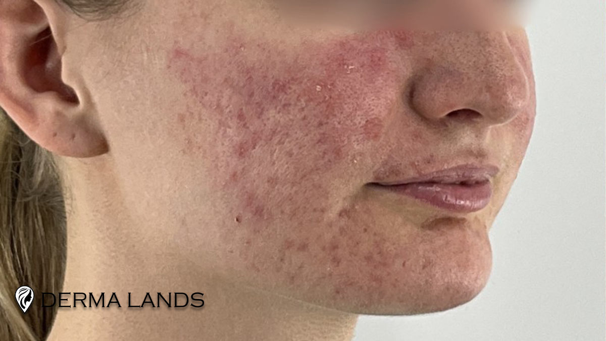 روتین بعد از ایزوترتینوئین