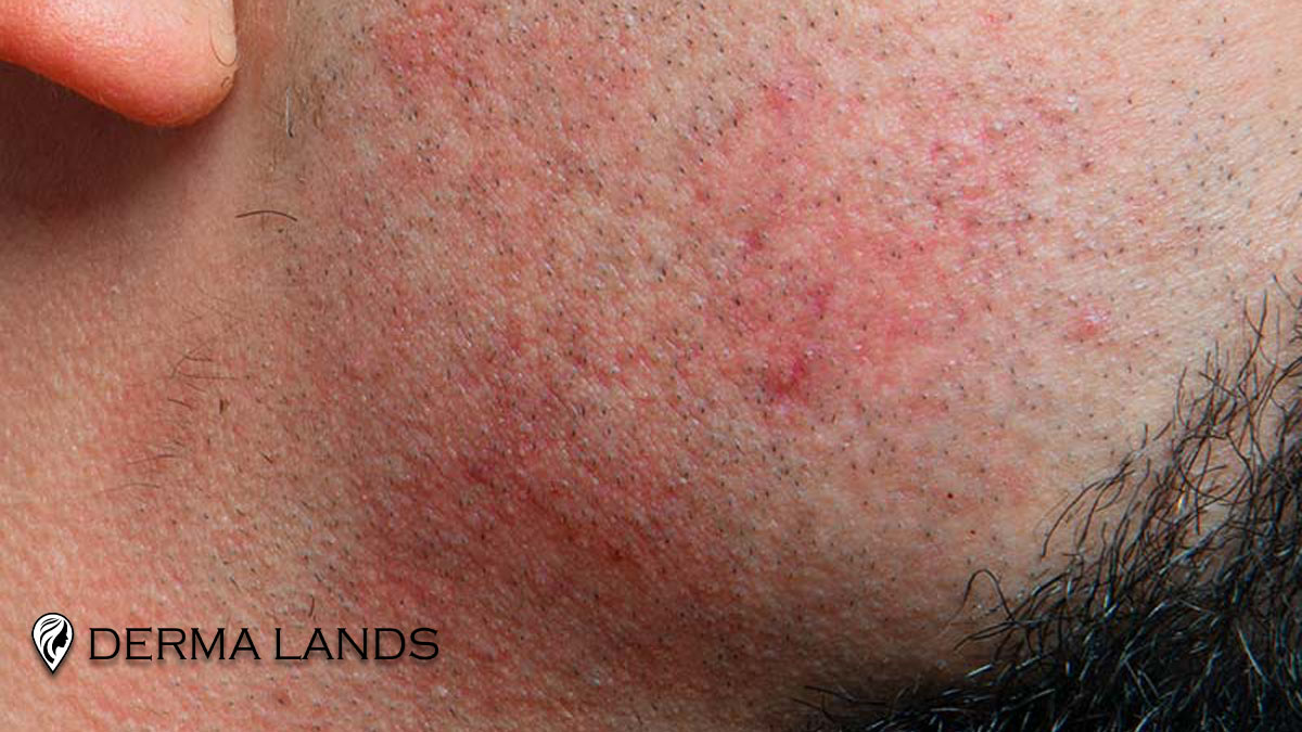 آکنه بعد از اصلاح با تیغ