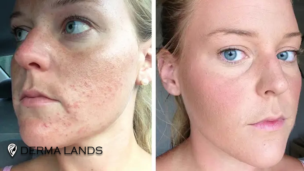 بنزوئیل پراکساید برای آکنه: شوینده یا ژل موضعی؟ راهنمای انتخاب و کم‌کردن عوارض